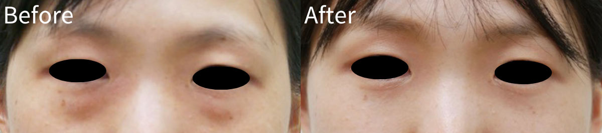 30代女性（術前/術後1ヶ月）