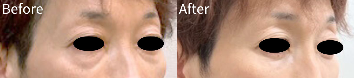 60代女性（術前/術後1ヶ月）