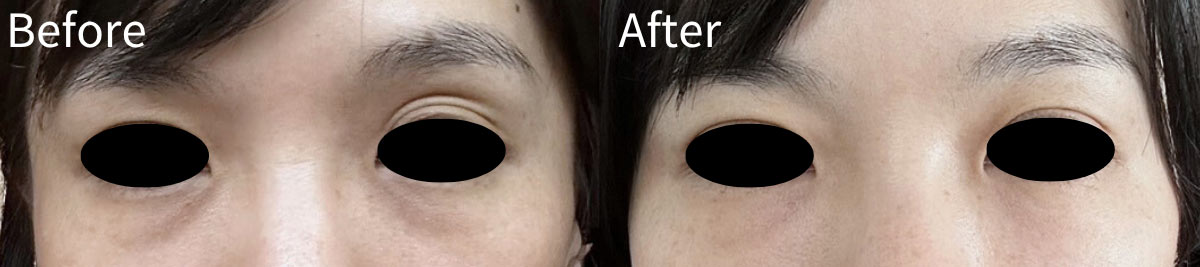 30代女性（注入前/注入翌日）